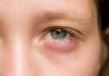 ¿Te levantas con los ojos hinchados? Estas pueden ser las causas ojos hinchados